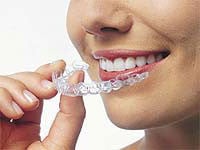 Invisalign Clear Braces